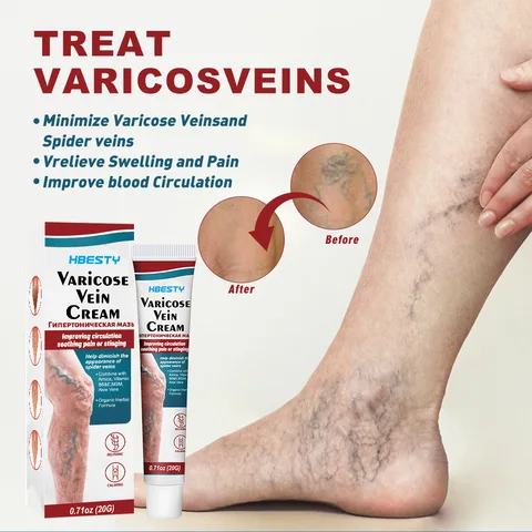 Varicose Vein Treatment Cream (Hot Sale)